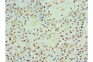 Immunohistochemistry of paraffin-embedded human breast cancer using ABIN7146438 at dilution of 1:100 (CAMK1G antibody  (AA 217-476))