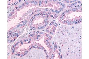 Anti-OR51E1 antibody IHC of human Prostate, Carcinoma. (OR51E1 antibody  (Cytoplasmic Domain))