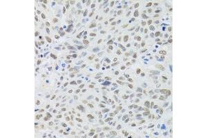 Immunohistochemistry of paraffin-embedded human lung cancer using DDB1 Antibody. (DDB1 antibody)