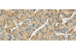 Immunohistochemistry of paraffin-embedded Human liver cancer using TMPRSS11D Polyclonal Antibody at dilution of 1/35 (TMPRSS11D antibody)