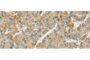 Immunohistochemistry of paraffin-embedded Human liver cancer using TMPRSS11D Polyclonal Antibody at dilution of 1/35