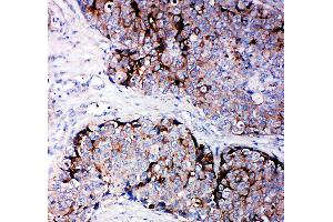 Anti-TIMP2 antibody, IHC(P) IHC(P): Human Mammary Cancer Tissue (TIMP2 antibody  (C-Term))