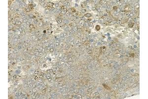 ABIN6260125 and ABIN6279152 at 1/100 staining human melanoma by IHC-P.