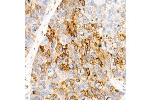 Immunohistochemistry of paraffin-embedded Human esophageal cancer using  antibody (ABIN7265531) at dilution of 400(40x lens). (ALDH1A1 antibody)