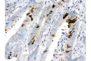 ITLN1 was detected in paraffin-embedded sections of human intestinal cancer tissues using rabbit anti- ITLN1 Antigen Affinity purified polyclonal antibody (Catalog # ) at 1 µg/mL. (ITLN1/Omentin antibody  (N-Term))