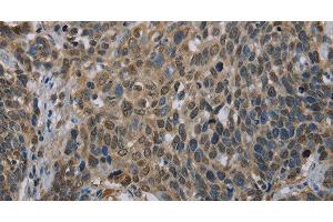 Immunohistochemistry of paraffin-embedded Human cervical cancer using UBP1 Polyclonal Antibody at dilution of 1:40 (UBP1 antibody)