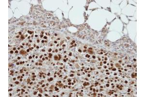 IHC-P Image Immunohistochemical analysis of paraffin-embedded ES2 xenograft, using CIZ1, antibody at 1:500 dilution.