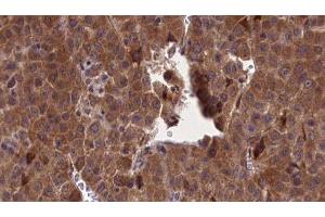 ABIN6277173 at 1/100 staining Human liver cancer tissue by IHC-P. (Selectin E/CD62e antibody  (N-Term))