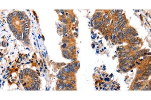 Immunohistochemistry of paraffin-embedded Human colon cancer using NCK1 Polyclonal Antibody at dilution of 1:30 (NCK1 antibody)