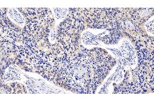 Detection of MAPK14 in Human Bladder Cancer Tissue using Polyclonal Antibody to Mitogen Activated Protein Kinase 14 (MAPK14)