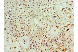 Immunohistochemistry of paraffin-embedded human breast cancer using ABIN7144280 at dilution of 1:100 (Annexin IV antibody  (AA 110-319))