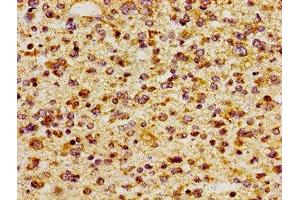 Immunohistochemistry of paraffin-embedded human glioma using ABIN7156468 at dilution of 1:100 (CD51 antibody  (AA 775-885))