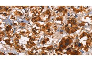 Immunohistochemistry of paraffin-embedded Human thyroid cancer tissue using ATRN Polyclonal Antibody at dilution 1:50 (Attractin antibody)