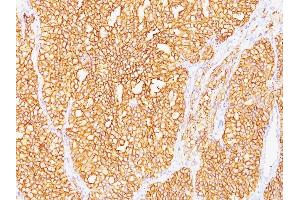 Formalin-fixed, paraffin-embedded human Renal Cell Carcinoma stained with RCC Monoclonal Antibody (SPM487).