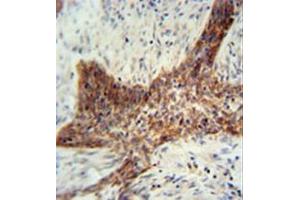 Formalin fixed, paraffin embedded human lung carcinoma stained with RILPL2 Antibody (Center) followed by peroxidase conjugation of the secondary antibody and DAB staining. (RILPL2 antibody  (Middle Region))