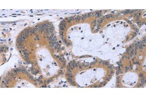 Immunohistochemistry of paraffin-embedded Human colon cancer using MAPRE3 Polyclonal Antibody at dilution of 1:30 (ECE1 antibody)