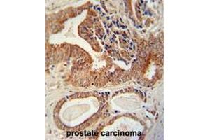 IGF2BP1 antibody (C-term) immunohistochemistry analysis in formalin fixed and paraffin embedded human prostate carcinoma followed by peroxidase conjugation of the secondary antibody and DAB staining. (IGF2BP1 antibody  (C-Term))