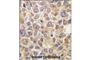 Formalin-fixed and paraffin-embedded human breast carcinoma tissue reacted with AT(Slc29a4) Antibody (N-term) (ABIN387943 and ABIN2844504) , which was peroxidase-conjugated to the secondary antibody, followed by DAB staining. (SLC29A4 antibody  (N-Term))