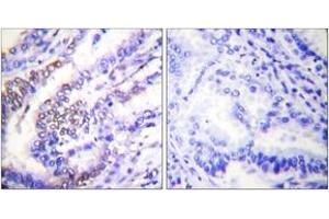 Immunohistochemistry analysis of paraffin-embedded human lung carcinoma tissue, using Cyclin E1 Antibody. (Cyclin E1 antibody  (AA 91-140))