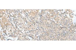 Immunohistochemistry of paraffin-embedded Human tonsil tissue using SLC26A3 Polyclonal Antibody at dilution of 1:35(x200) (SLC26A3 antibody)