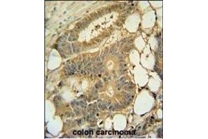 EPS8L3 Antibody (N-term) (ABIN390898 and ABIN2841105) immunohistochemistry analysis in formalin fixed and paraffin embedded human colon carcinoma followed by peroxidase conjugation of the secondary antibody and DAB staining. (EPS8-Like 3 antibody  (N-Term))