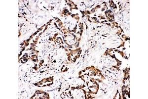 IHC-P: APLP1 antibody testing of human lung cancer tissue (APLP1 antibody  (N-Term))