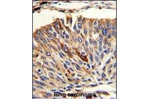 Formalin-fixed and paraffin-embedded human lung carcinoma with VTI1A Antibody (C-term), which was peroxidase-conjugated to the secondary antibody, followed by DAB staining. (VTI1A antibody  (C-Term))