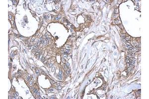 IHC-P Image Immunohistochemical analysis of paraffin-embedded human gastric cancer, using S100A10, antibody at 1:500 dilution. (S100A10 antibody)
