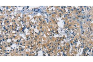 Immunohistochemistry of paraffin-embedded Human thyroid cancer tissue using BMPR1B Polyclonal Antibody at dilution 1:30 (BMPR1B antibody)