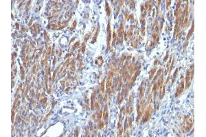 Formalin-fixed, paraffin-embedded human Leiomyosarcoma stained with SM-MHC Monoclonal Antibody (SMMS-1). (MYH11 antibody)