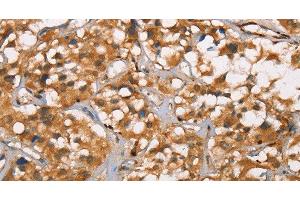 Immunohistochemistry of paraffin-embedded Human thyroid cancer tissue using DICER1 Polyclonal Antibody at dilution 1:40 (DICER1 antibody)