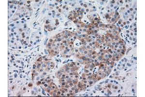 Immunohistochemical staining of paraffin-embedded Carcinoma of kidney tissue using anti-SERPINA1mouse monoclonal antibody.