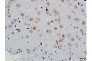 Formalin-fixed and paraffin embedded human colon carcinoma labeled with Anti-ID1 Polyclonal Antibody, Unconjugated (ABIN700330) at 1:200 followed by conjugation to the secondary antibody and DAB staining (ID1 antibody  (AA 51-155))