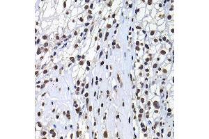 Immunohistochemistry of paraffin-embedded human kidney cancer using H2AFY antibody at dilution of 1:100 (x400 lens). (H2AFY antibody)