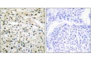 Immunohistochemistry analysis of paraffin-embedded human liver carcinoma tissue, using DNMT3B Antibody. (DNMT3B antibody  (AA 1-50))