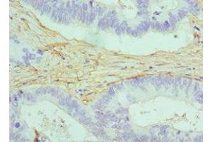 Immunohistochemistry of paraffin-embedded human colon cancer using ABIN7146462 at dilution of 1:100 (Caldesmon antibody  (AA 1-240))