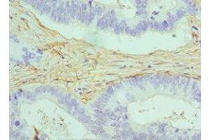 Immunohistochemistry of paraffin-embedded human colon cancer using ABIN7146462 at dilution of 1:100 (Caldesmon antibody  (AA 1-240))