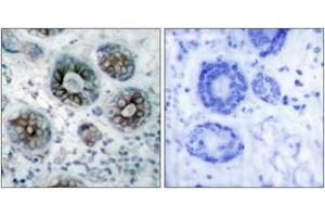 Immunohistochemistry analysis of paraffin-embedded human breast carcinoma tissue, using GAP43 (Ab-41) Antibody. (GAP43 antibody  (AA 8-57))