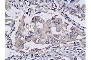 Formalin-fixed and paraffin embedded human colon cancer labeled with Anti-TRAILR2/DR5/CD262 Polyclonal Antibody, Unconjugated (ABIN733118) followed by conjugation to the secondary antibody and DAB staining (TNFRSF10B antibody  (AA 301-381))