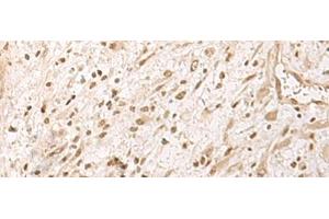 Immunohistochemistry of paraffin-embedded Human ovarian cancer tissue using RRP1 Polyclonal Antibody at dilution of 1:45(x200) (RRP1 antibody)