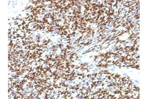 Formalin-fixed, paraffin-embedded human Rhabdomyosarcoma stained with PAX7 Monoclonal Antibody (SPM613). (PAX7 antibody  (AA 301-505))