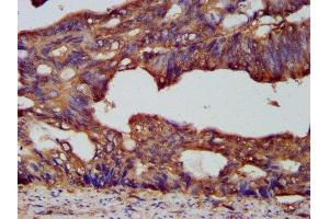 IHC image of ABIN7164828 diluted at 1:200 and staining in paraffin-embedded human colon cancer performed on a Leica BondTM system.
