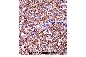 EIF5A2 Antibody (C-term) ((ABIN657973 and ABIN2846919))immunohistochemistry analysis in formalin fixed and paraffin embedded human ovarian carcinoma followed by peroxidase conjugation of the secondary antibody and DAB staining. (EIF5A2 antibody  (C-Term))