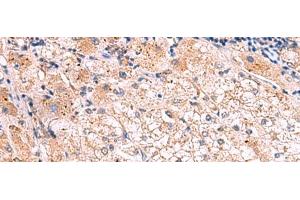 Immunohistochemistry of paraffin-embedded Human liver cancer tissue using KLK9 Polyclonal Antibody at dilution of 1:50(x200) (Kallikrein 9 antibody)