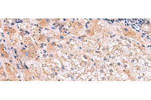 Immunohistochemistry of paraffin-embedded Human liver cancer tissue using KLK9 Polyclonal Antibody at dilution of 1:50(x200)
