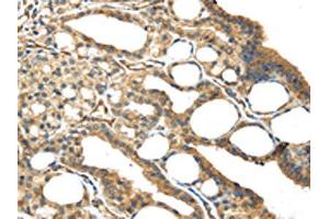 The image on the left is immunohistochemistry of paraffin-embedded Human thyroid cancer tissue using ABIN7191125(ISM2 Antibody) at dilution 1/45, on the right is treated with synthetic peptide. (Isthmin 2 antibody)