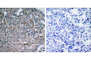 Peptide - +Immunohistochemical analysis of paraffin-embedded human breast carcinoma tissue using FAK (Ab-925) antibody (#B7083). (FAK antibody  (Tyr925))