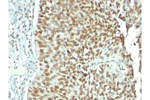 Formalin-fixed, paraffin-embedded human bladder carcinoma stained with Nucleolin antibody.