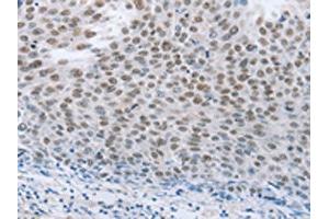 The image on the left is immunohistochemistry of paraffin-embedded Human liver cancer tissue using ABIN7191633(NEUROG2 Antibody) at dilution 1/15, on the right is treated with synthetic peptide. (Neurogenin 2 antibody)