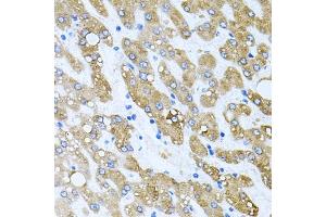 Immunohistochemistry of paraffin-embedded human liver damage using TOB2 antibody (ABIN6128831, ABIN6149377, ABIN6149378 and ABIN6223057) at dilution of 1:100 (40x lens).